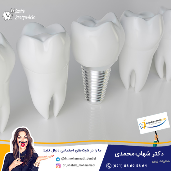 جراحی ایمپلنت چیست؟ - کلینیک دندانپزشکی دکتر شهاب محمدی